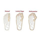Bunion Corrector Splint Brace Post Surgery Big Toe Straightener & Separator - StabilityPro™